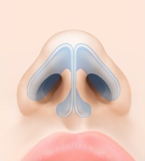 수술 전 — 두꺼운 피하조직으로 코끝이 뭉툭한 코의 해부 일러스트