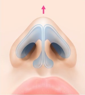 수술 후 — 지방 제거 후 코끝이 정리되어 올라간 상태의 해부 일러스트
