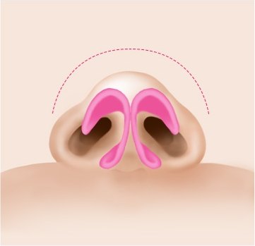 망울 코끝(Bulbous tip) 해부 일러스트 — 둥근 아치형 점선 가이드