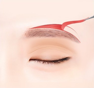 늘어진 피부 제거 — 절개된 붉은 피부와 근육 띠를 은색 수술기구가 집어 들어올리는 의학 일러스트