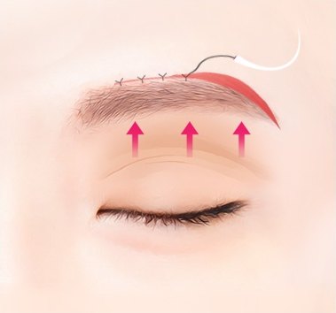 섬세 봉합 — 눈썹 위 절개선을 검은 실로 봉합하고 눈썹이 올라가는 방향을 분홍 화살표 3개로 표시한 의학 일러스트