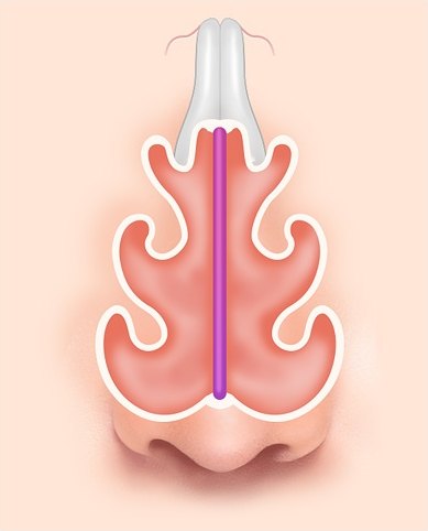 정상 비중격 해부 일러스트 — 코 내부(비강) 단면에서 비중격이 휘지 않고 정중앙에 곧게 서 있는 상태