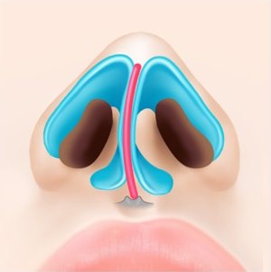 정면에서 본 코 내부 해부 일러스트 — 비중격연골이 한쪽으로 휘어져 있는 수술 전 상태