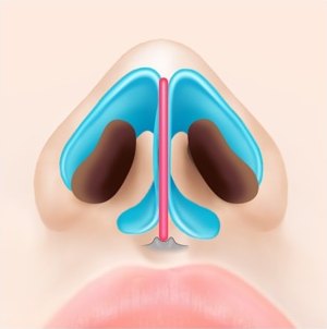 코 내부 해부 일러스트 — 휘었던 비중격연골이 곧게 펴져 정중앙에 수직으로 선 상태
