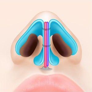 코 내부 해부 일러스트 — 덧댄 연골과 비중격연골을 실로 두 군데 묶어 고정한 상태