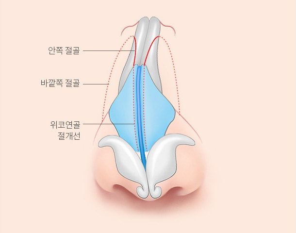 정면에서 본 코 해부 일러스트 — 휘어진 코뼈와 비중격(하늘색), 콧날개연골(흰색)에 안쪽 절골, 바깥쪽 절골, 위코연골 절개선을 지시선으로 표시한 수술 설명도