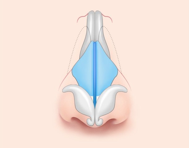 절골 후 좌우 대칭으로 바르게 정렬된 코의 정면 해부 일러스트 — 코뼈가 일직선으로 서고 비중격(하늘색)이 중앙에 곧게 위치