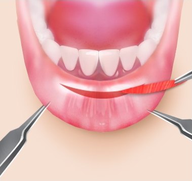 입이 돌출된 경우 근육까지 제거 — 절제면이 넓게 표시된 구강 내부 일러스트