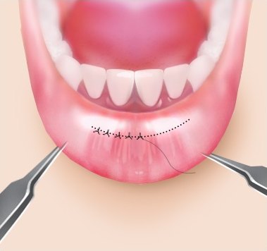 미세 봉합 — 아랫입술 안쪽 봉합선과 실을 당기는 핀셋 일러스트