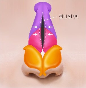 절단면을 사이에 두고 좌우 화살표로 코뼈를 모으는 과정을 그린 정면 해부 일러스트 (라벨: 절단된 면)