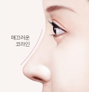 매끄러운 코라인이 된 수술 후 옆얼굴 일러스트 (라벨: 매끄러운 코라인)