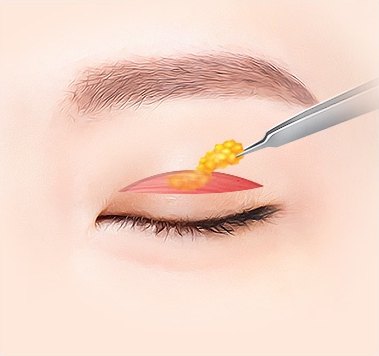 절개창으로 수술기구를 넣어 눈꺼풀의 지방을 제거하는 일러스트