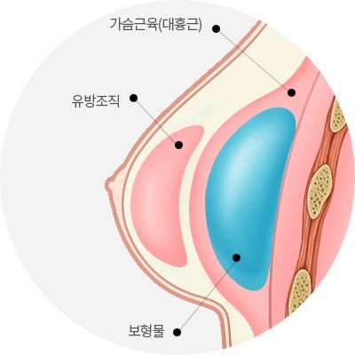 보형물이 가슴근육 아래에 놓인 상태를 보여주는 가슴 단면 해부 도해 — 라벨 ‘가슴근육(대흉근)’, ‘유방조직’, ‘보형물’