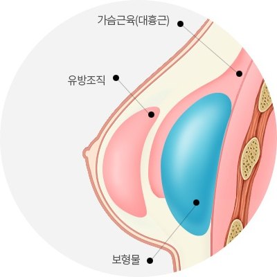 보형물 윗부분은 근육 아래, 아랫부분은 유선조직 아래에 걸친 이중평면 상태의 가슴 단면 해부 도해 — 라벨 ‘가슴근육(대흉근)’, ‘유방조직’, ‘보형물’