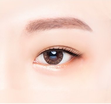 또렷하게 교정된 뜬 눈 클로즈업 일러스트 — 수술 후 상태
