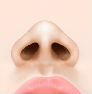 넓은 콧볼과 큰 콧구멍 상태의 코 정면 일러스트 — 수술 전