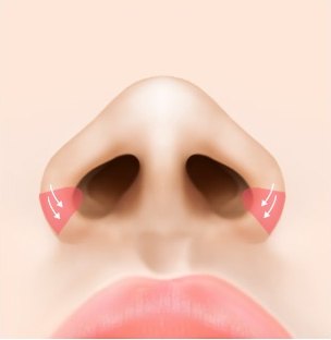 콧구멍 위주로 외측 또는 내측 절개선을 표시한 코 일러스트