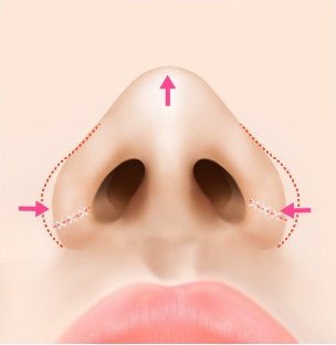 절제 후 봉합 방향을 화살표로 표시한 코 일러스트