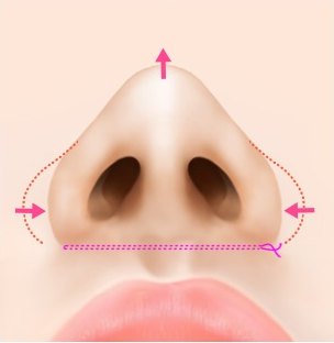 실을 당겨 콧볼을 가운데로 모으는 방향을 표시한 코 일러스트