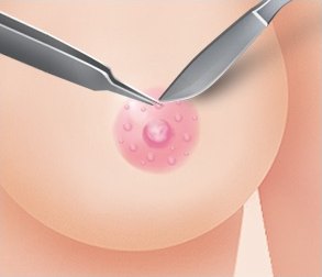 은색 수술 겸자와 가위가 V 자로 교차하며 유륜의 돌기를 제거하는 일러스트