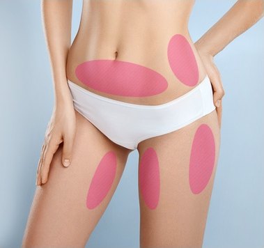 속옷 차림 여성의 복부와 허벅지에 지방 채취 부위가 분홍 타원으로 표시된 사진
