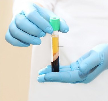 파란 장갑을 낀 손이 지방층과 혈액층이 분리된 시험관을 들고 있는 장면