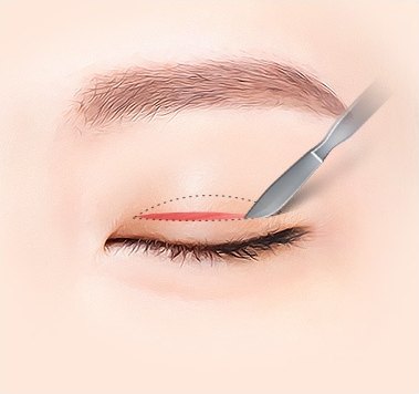 점선 디자인을 따라 눈꺼풀에 붉은 절개선이 생기고 수술용 메스가 들어오는 일러스트
