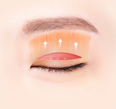 눈꺼풀 안쪽 올림근 섬유가 드러나고 위쪽 화살표와 봉합 표시가 그려진 일러스트