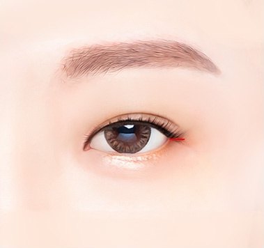 눈가 주름을 따라 바깥쪽을 미세 절개하는 과정 일러스트