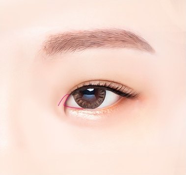 내안각을 따라 몽고주름을 절개하는 과정 일러스트