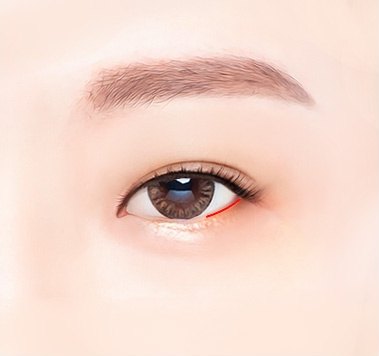 결막 안쪽을 절개해 근막조직을 연결하는 과정 일러스트