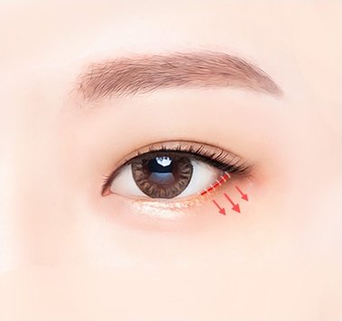 45도 방향으로 당긴 뒤 봉합하는 과정 일러스트