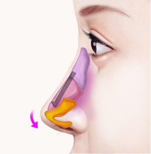 아래로 고정 — 이식한 조직으로 코끝을 내려주는 과정 일러스트