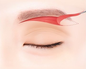 눈썹하거상 — 눈썹 바로 아랫부분 절개선과 절제 범위를 표시한 눈 클로즈업 일러스트