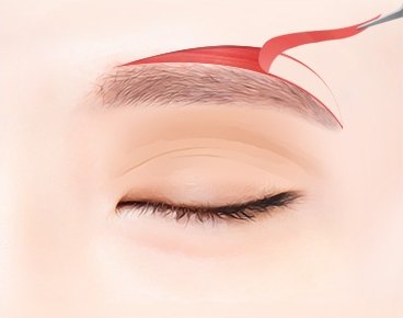 눈썹위거상 — 눈썹 바로 윗부분 절개선을 표시한 눈 클로즈업 일러스트